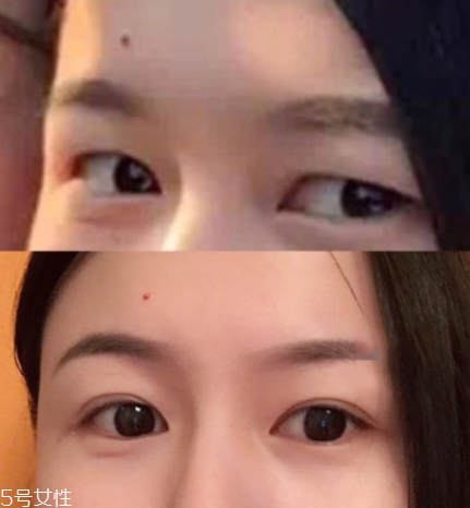 內(nèi)雙怎么進(jìn)化成雙眼皮？全是雙眼皮貼的功勞