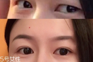 內(nèi)雙怎么進(jìn)化成雙眼皮？全是雙眼皮貼的功勞