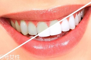 牙齒發(fā)黃是天生的嗎？只是你刷牙偷懶了