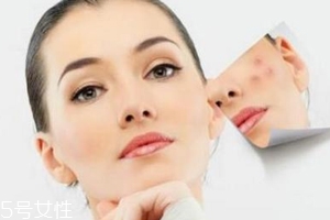 痘印多久能自行消失？多數(shù)人一年內(nèi)消失