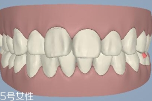 磨牙有哪些癥狀？牙齒變形甚至脫落