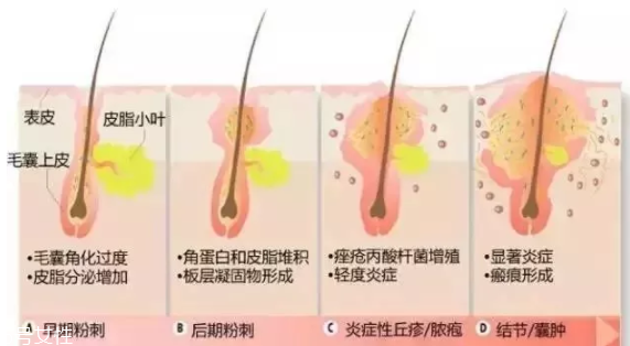 封閉性粉刺的發(fā)病機(jī)制是什么？角質(zhì)層太厚