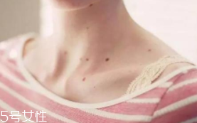 色素痣是腫瘤嗎？良性腫瘤不必?fù)?dān)心