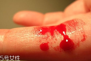 血友病的主要表現(xiàn)有哪些？出血是最明顯的特征