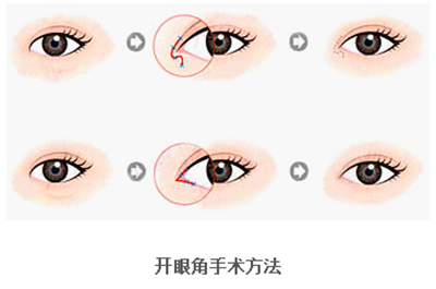 開眼角疤痕多久消失？開眼角的適宜人群