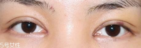 怎么縮短開眼角疤痕消失時間？雙眼皮開眼角恢復(fù)過程