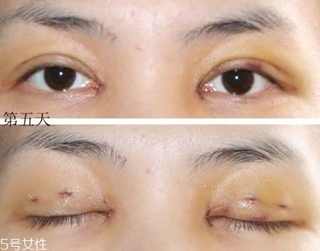 怎么縮短開眼角疤痕消失時間？雙眼皮開眼角恢復(fù)過程