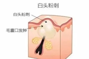 閉口是怎么引起的？4種情況要注意
