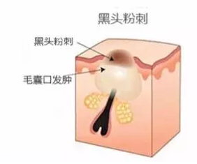 閉口是怎么引起的？4種情況要注意