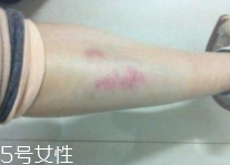 身體淤青怎么來的？不是磕碰那么簡單