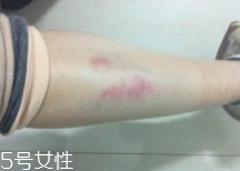 摔傷了涂什么藥好的快？做好消毒才能愈合快