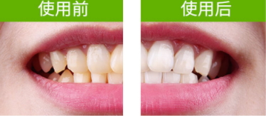 牙貼怎么分上下牙貼？牙貼怎么分正反