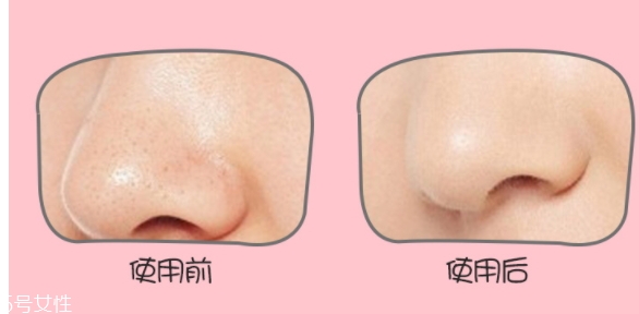 yoii黑頭儀怎么用？yoii黑頭儀怎么充電