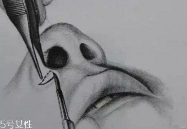 鼻翼外切多久消腫？鼻翼外切消腫時間要多長？