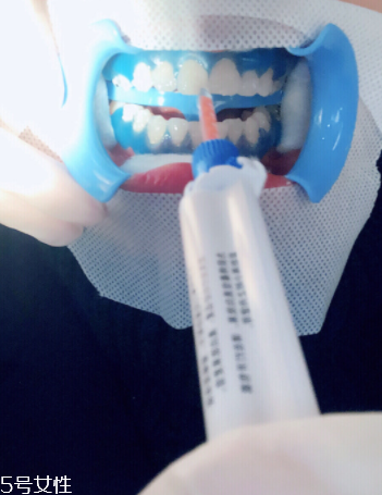 冷光美白會(huì)反彈嗎？冷光美白心得