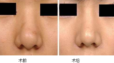 縮鼻手術多久恢復？縮鼻手術傷口才會好