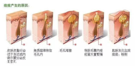 頑固痘痘怎么消除？油皮為什么反復(fù)爆痘？