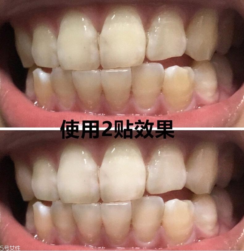 佳潔士美白牙貼貼多久有效？佳潔士美白牙貼使用感受