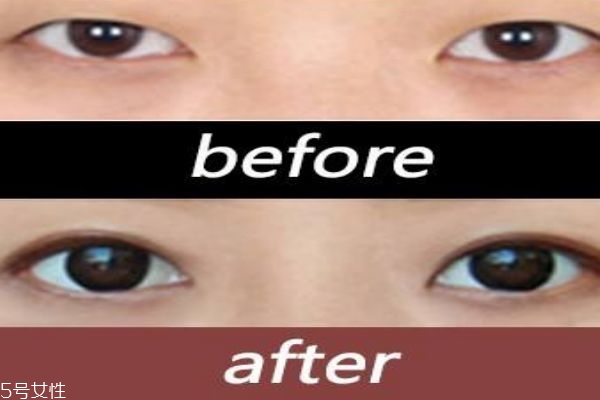 韓式三點(diǎn)雙眼皮的缺點(diǎn) 韓式三點(diǎn)雙眼皮的優(yōu)勢
