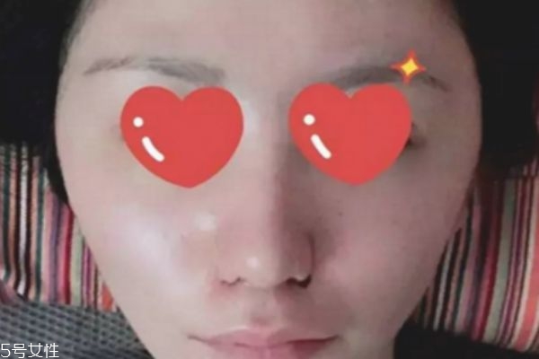 鼻翼內切是切鼻基底嗎 鼻翼內切效果圖