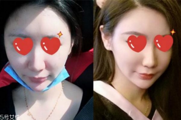鼻翼內切是切鼻基底嗎 鼻翼內切效果圖