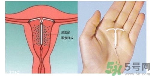 上環(huán)是什么意思？上環(huán)后注意事項有哪些？