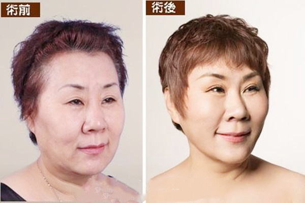 拉皮手術(shù)多久能恢復 拉皮手術(shù)會留疤嗎