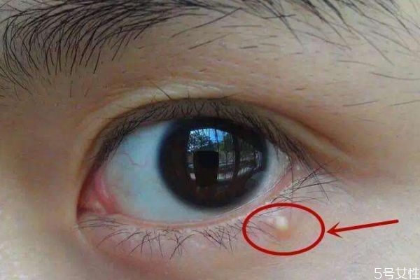 為什么涂眼霜會(huì)長脂肪粒呢 什么是脂肪粒呢