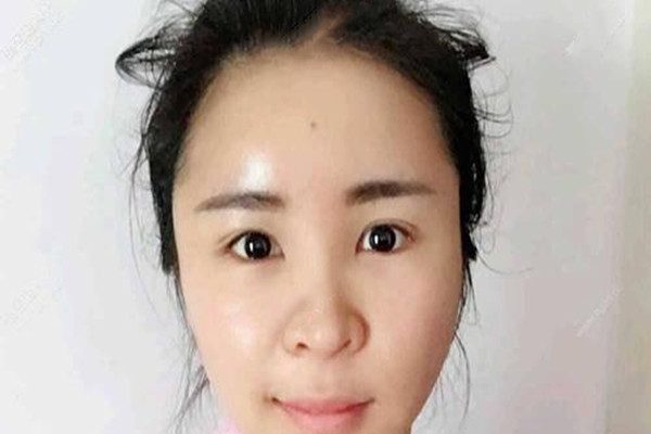 無痕去眼袋會(huì)不會(huì)反彈 無痕去眼袋比傳統(tǒng)去眼袋的優(yōu)勢(shì)