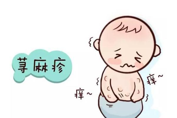 蕁麻疹是否有傳染 蕁麻疹是屬于過(guò)敏體質(zhì)嗎