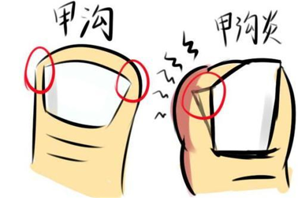 甲溝炎要拔掉整個(gè)指甲嗎 甲溝炎指甲拔了還能在長出來嗎
