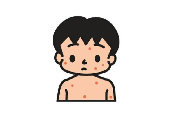 小兒風疹可以吹空調(diào)嗎 小兒風疹可以出門嗎