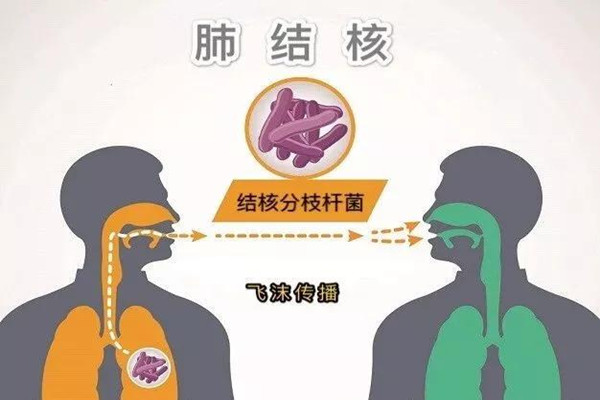 肺結(jié)核會(huì)引起淋巴結(jié)腫大嗎 肺結(jié)核會(huì)引起胸腔積液?jiǎn)?></a>
<p class=