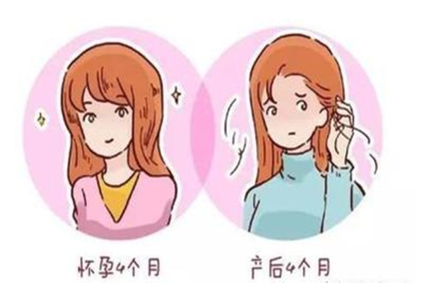 產后會脫發(fā)嗎 產后脫發(fā)什么原因