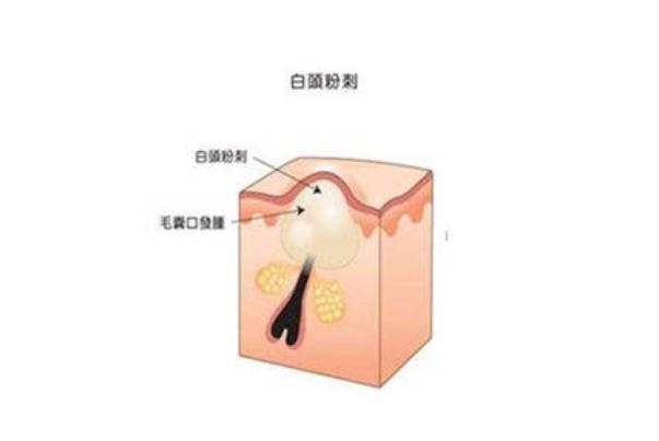 粉刺對身體有什么影響 擠黑頭粉刺會(huì)對皮膚有哪些影響