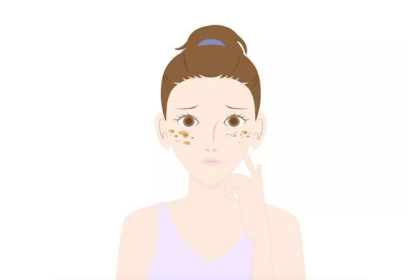 曬斑是什么樣子的 曬斑是因?yàn)榉罆駴](méi)做好嗎