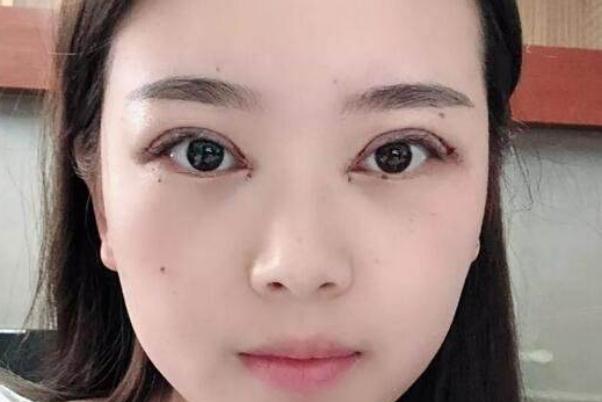 割雙眼皮需要多少錢(qián)一次 割雙眼皮大概多久能恢復(fù)正常