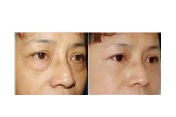 去眼袋手術(shù)會(huì)把臥蠶去掉嗎 去眼袋手術(shù)對眼有傷害嗎
