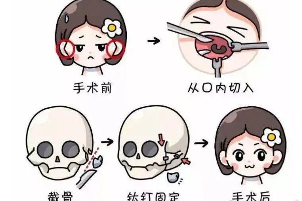 顴骨內推和磨骨哪個風險大 顴骨內推的危害