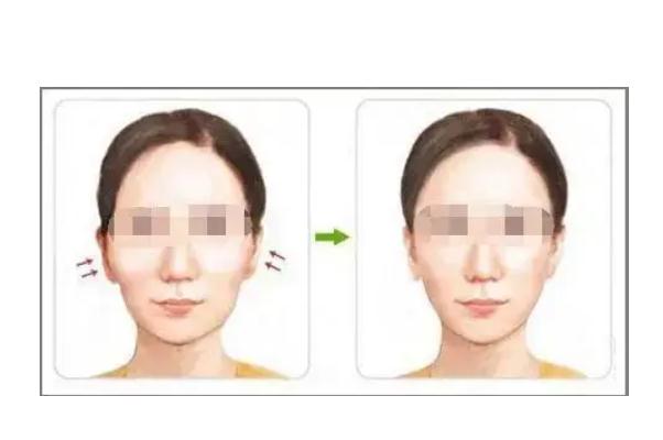 顴骨內推和磨骨哪個風險大 顴骨內推的危害