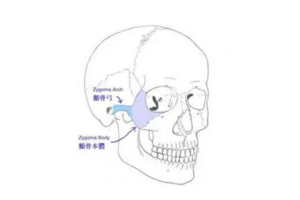 顴骨內(nèi)推要開刀嗎 顴骨內(nèi)推有生命危險(xiǎn)嗎